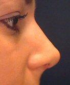 Nose Surgery (Rhinoplasty)