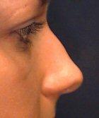 Nose Surgery (Rhinoplasty)