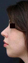 29 yr old Female undergoes a Chin Implant in Liposuction