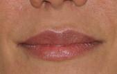 Great Lips With Lip Augmentation