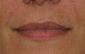 Great Lips With Lip Augmentation