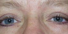 Eyelid Surgery (Blepharoplasty)