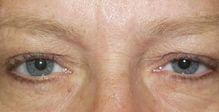 Eyelid Surgery (Blepharoplasty)