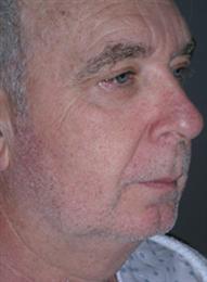 Male Facelift and Browlift