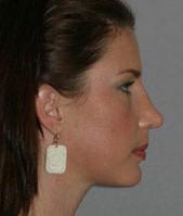 Great Profile with Genioplasty (Chin Advancement)