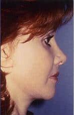 Rhinoplasty with Facelift, Necklift, and More