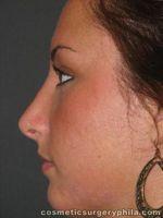 Nose Surgery (Rhinoplasty) for Young Female