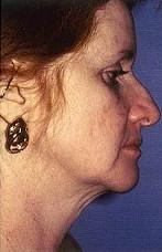 Rhinoplasty with Facelift, Necklift, and More