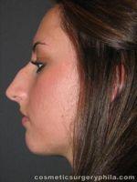 Nose Surgery (Rhinoplasty) for Young Female