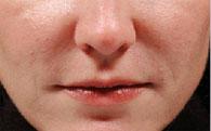 Dermal Juvederm Injections