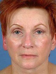 Facelift and Eyelid Surgery Restore Youth