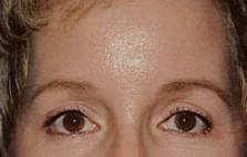 Great Results From Forehead Lift
