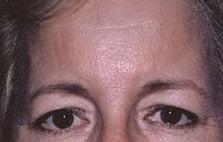 Great Results From Forehead Lift