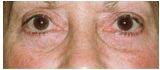 Eyelid Surgery – Blepharoplasty