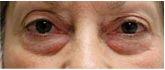 Eyelid Surgery – Blepharoplasty
