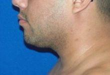 Neck Liposuction for Male Patient
