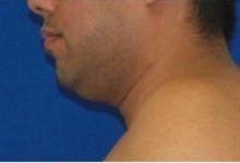 Neck Liposuction for Male Patient