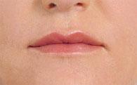 Dermal Juvederm Injections