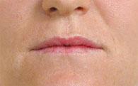 Dermal Juvederm Injections