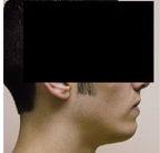 Male Chin Augmentation