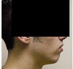 Male Chin Augmentation
