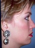 Chin Augmentation With Neck Liposuction