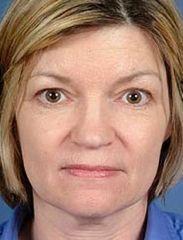 Facelift and Eyelid Surgery