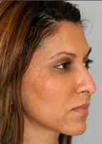 Beautiful Results On Rhinoplasty Patient