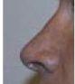 Female Nose Surgery – Rhinoplasty